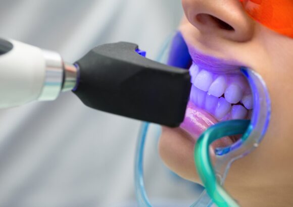 Teeth Whitening - South Boston Dental Care Teeth Whitening - South Boston Dental Care